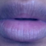 Lip Discoloration