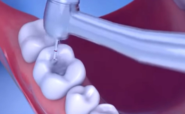 Cavity Filling – All You wanted to know